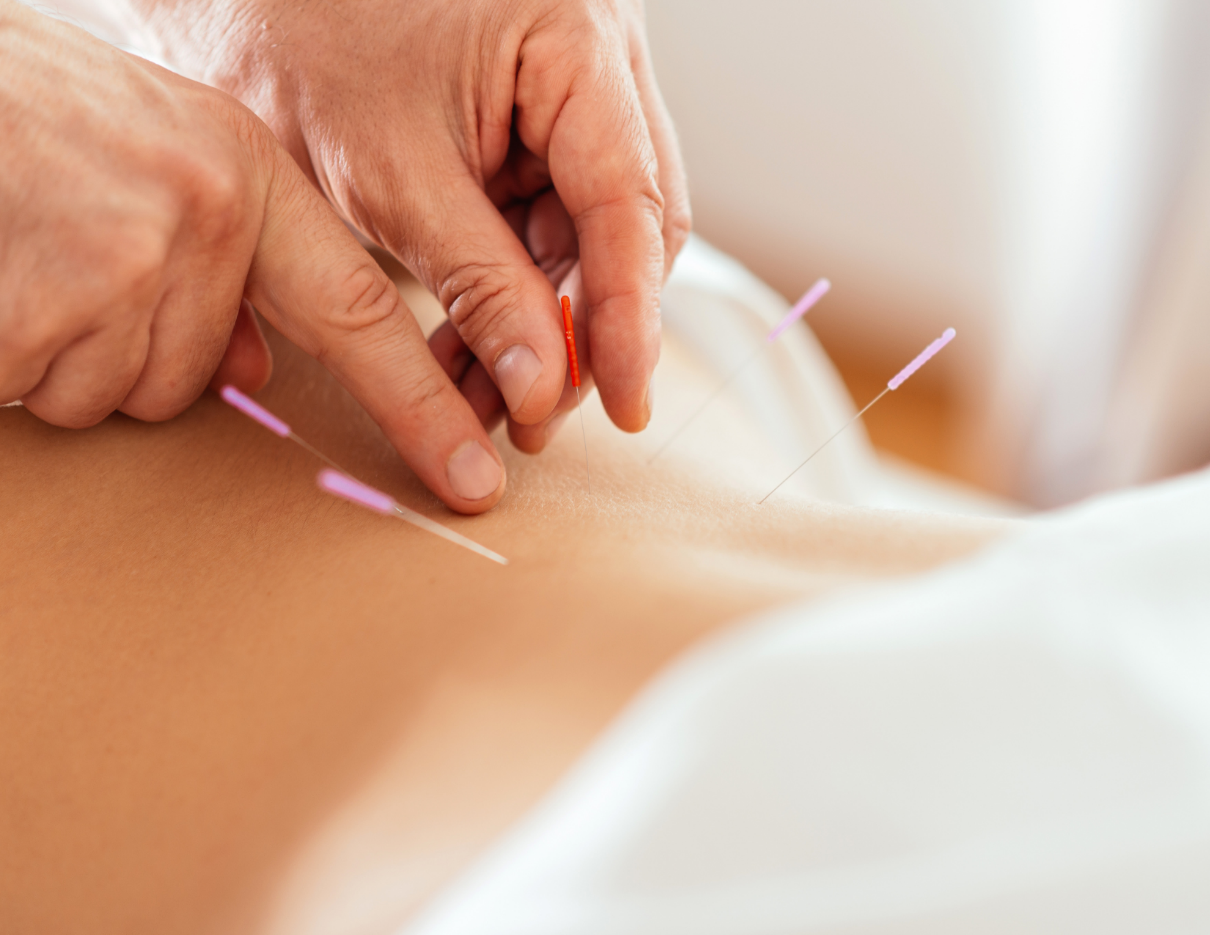 FAQ About Acupuncture For Pain : What to expect
