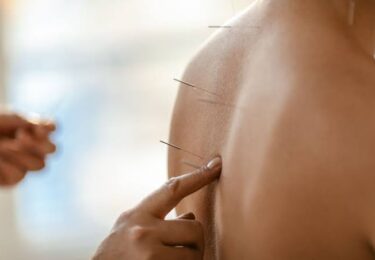How Acupuncture in Evanston May Support Natural Pain Relief