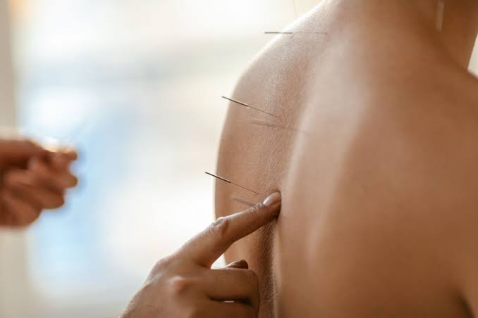 How Acupuncture in Evanston May Support Natural Pain Relief